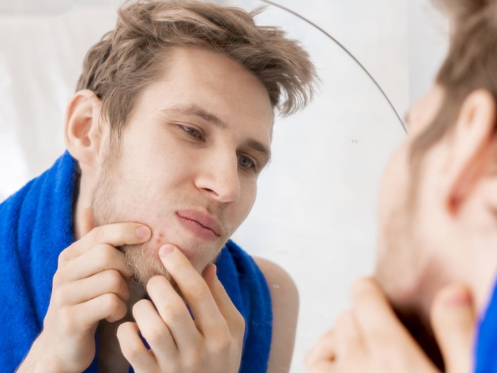 man acne problem solution - 男士护肤指南：减轻痘痘和暗疮问题